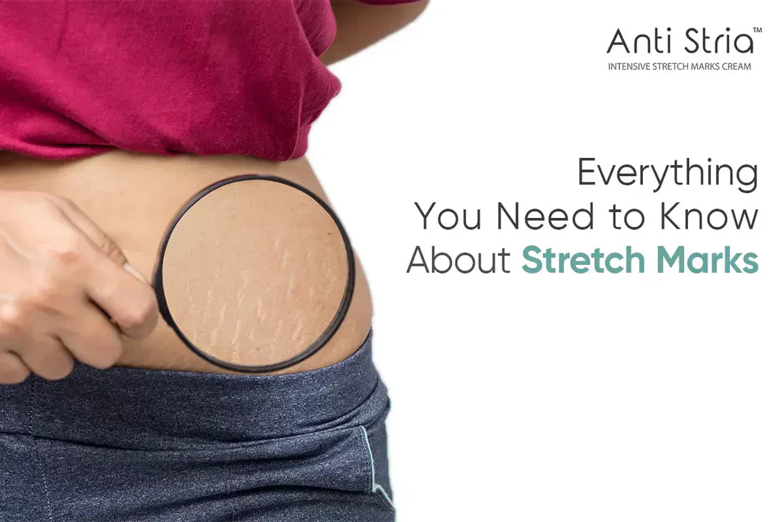 Everything You Need to Know About Stretch Marks