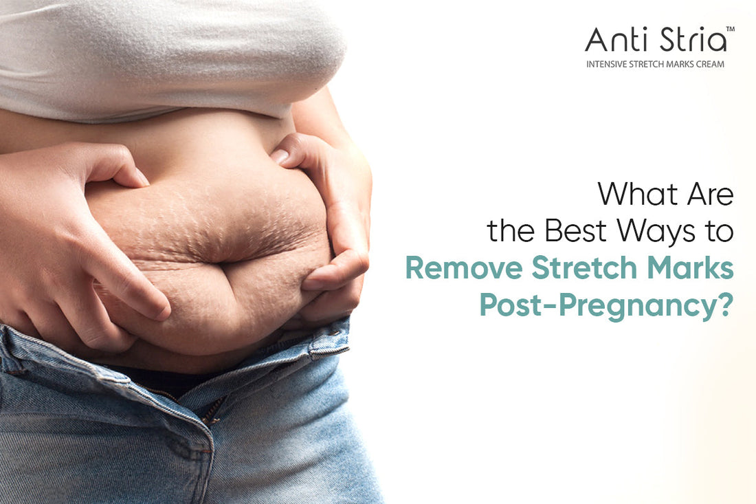 stretch marks after pregnancy